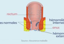 Tout sur les hémorroïdes Sante Tout sur les hemorroides