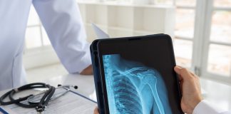 Comment soigner une fracture de l'épaule ? Comment soigner une fracture de l039epaule
