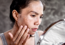 Taches brunes au soleil : voici l’astuce toute simple pour les éviter, d’après un célèbre chirurgien esthétique Taches-brunes-au-soleil-voici-lastuce-toute-simple-pour-les-eviter-dapres-un-celebre-chirurgien-esthetique