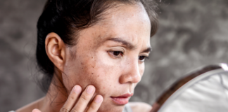 Taches brunes au soleil : voici l’astuce toute simple pour les éviter, d’après un célèbre chirurgien esthétique Taches-brunes-au-soleil-voici-lastuce-toute-simple-pour-les-eviter-dapres-un-celebre-chirurgien-esthetique