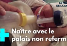 La séquence Pierre Robin La-sequence-Pierre-Robin-