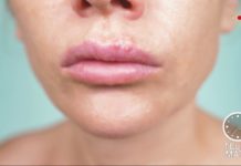 Herpès labial : éviter la contagion Sante-Herpes-labial-eviter-la-contagion