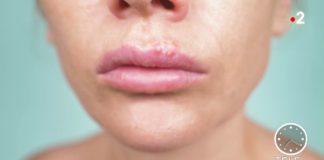 Herpès labial : éviter la contagion Sante-Herpes-labial-eviter-la-contagion
