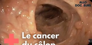 Cancer colorectal : quelle prise en charge ? Cancer-colorectal-quelle-prise-en-charge-Allo-Docteurs