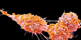 Cancer de l’ovaire : le rôle des plaquettes sanguines en question Cancer-de-lovaire-le-role-des-plaquettes-sanguines-en-question