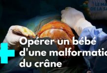 Craniosténose : naitre avec les os du crâne soudés Craniostenose-naitre-avec-les-os-du-crane-soudes-L