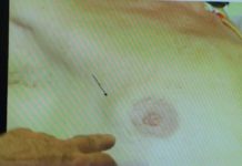 Les hommes aussi sont confrontés au cancer du sein Sante-Le-cancer-du-sein-au-masculin