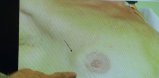 Les hommes aussi sont confrontés au cancer du sein Sante-Le-cancer-du-sein-au-masculin