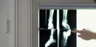 Tout sur l’entorse Sante-Tout-sur-lentorse