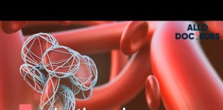 Thrombose : toutes vos questions Thrombose-toutes-vos-questions-Allo-Docteurs