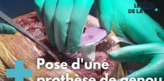 Toutes vos questions sur les prothèses de genou Toutes-vos-questions-sur-les-protheses-de-genou-Allo-Docteurs