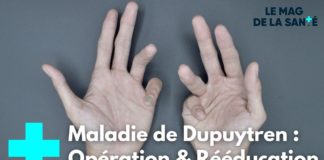La maladie de Dupuytren, où quand les doigts se rétractent Maladie-de-Dupuytren-quand-les-doigts-se-retractent-