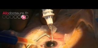 La chirurgie de la cataracte La-chirurgie-de-la-cataracte-Allo-Docteurs