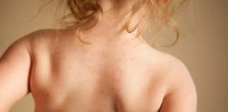 Comment et reconnaître et réagir face à l’urticaire chez bébé Lurticaire-chez-bebe-la-reconnaitre-et-reagir