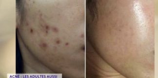 Acné, les adultes aussi en souffrent Sante-Acne-les-adultes-aussi