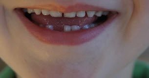 Pourquoi garder les dents de lait de vos enfants serait utile ? Sante -Garder-les-dents-de-lait-de-vos-enfants-pourrait-il-leur-sauver-la-vie-