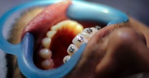 L’orthodontie pour les adultes est plus compliquée que ce qu’en pensent les réseaux sociaux Societe -Orthodontie-pour-les-adultes-c039est-moins-facile-que-ce-qu039en-disent-les-reseaux-sociaux