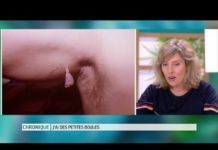 Comment se débarrasser des acrochordons ? Acrochordons-comment-sen-debarrasser-