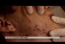 Comment éliminer les points noirs ? Comment-eliminer-ces-points-noirs-qui-nous-gachent-la-vie-