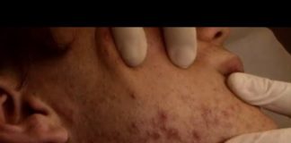 Comment éliminer les points noirs ? Comment-eliminer-ces-points-noirs-qui-nous-gachent-la-vie-