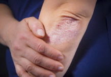 Comment diminuer les symptômes du psoriasis Peau -Diminuer-les-symptomes-du-psoriasis-cest-possible-et-voici-comment