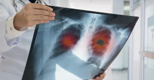 Les signes qui doivent vous alerter sur un cancer du poumon Sante -Cancer-du-poumon-les-signes-qui-doivent-vous-alerter