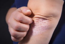 Le risque de diabète de type 2 augmenté par le psoriasis Sante -Le-psoriasis-augmente-le-risque-de-diabete-de-type-2