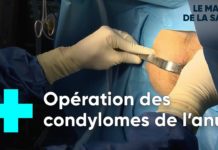 Traiter les lésions du papillomavirus Traiter-les-lesions-du-papillomavirus-