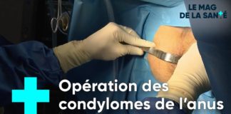 Traiter les lésions du papillomavirus Traiter-les-lesions-du-papillomavirus-