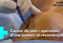 L’opération pour retirer une tumeur et reconstruire un sein Une-seule-operation-pour-retirer-une-tumeur-et-reconstruire-un-sein-