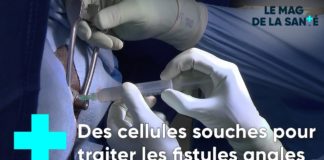 Réparer les fistules anales par la greffe de cellules souches La-greffe-de-cellules-souches-pour-reparer-les-fistules-anales-