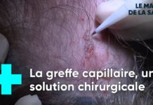 Eviter la calvitie grâce à la greffe de cheveux La-greffe-de-cheveux-pour-eviter-la-calvitie-