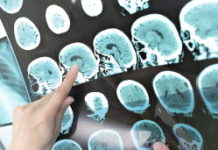 Cerveaux : pourquoi certains vieillissent plus vite que certains autres ? Sante -Pourquoi-certains-cerveaux-vieillissent-plus-vite-que-d039autres