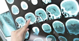 Cerveaux : pourquoi certains vieillissent plus vite que certains autres ? Sante -Pourquoi-certains-cerveaux-vieillissent-plus-vite-que-d039autres