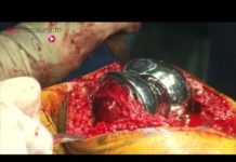 Une prothèse totale de genou en cas d’arthrose sévère Arthrose-et-prothese-totale-de-genou-Allo-Docteurs