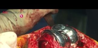 Une prothèse totale de genou en cas d’arthrose sévère Arthrose-et-prothese-totale-de-genou-Allo-Docteurs