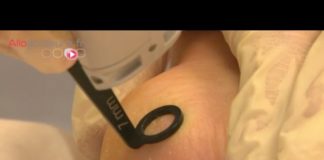 Le traitement radical des verrues : le laser Traitement-des-verrues-au-laser-une-methode-radicale-Allo-Docteurs