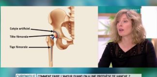 Prothèse de hanche et sexualité Comment-faire-lamour-avec-une-prothese-de-hanche-