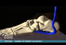 Varices : comment se forment-elles ? Comment-se-forment-les-varices-Allo-Docteurs