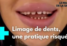 La tendance des influenceurs qui inquiète les médecins : les dents de requin Dents-de-requin-la-tendance-des-influenceurs-qui-inquiete-les-medecins-Le-M