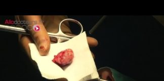 Amygdalectomie où l’ablation des amygdales Amygdalectomie-lablation-des-amygdales-Allo-Docteurs
