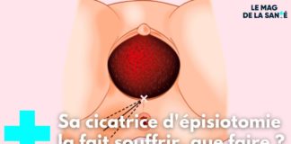 Que faire si la cicatrice d’épisiotomie fait mal Ma-cicatrice-depisiotomie-me-fait-mal-que-faire-