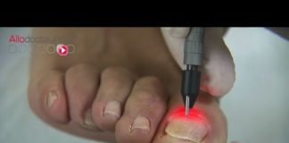 Le traitement au laser des mycoses des ongles Mycoses-des-ongles-le-traitement-au-laser-Allo-Docteurs