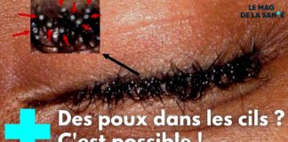D’où viennent les poux de cils et comment s’en débarrasser ? Poux-de-cils-dou-viennent-ils-et-comment-sen-debarrasser-