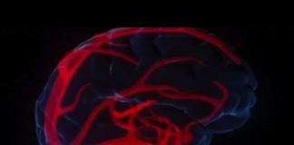 Une urgence absolue : la rupture d’anévrisme La-rupture-danevrisme-une-urgence-absolue-