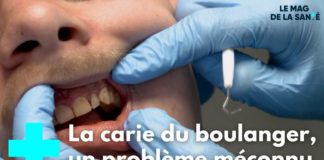 Comment prévenir la carie du boulanger ? Prevenir-la-carie-du-boulanger-