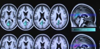 Plus de risque d’Alzheimer avec l’apnée du sommeil Sante-Apnee-du-sommeil-plus-de-risque-dAlzheimer