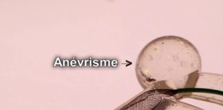 Un stent pour prévenir l’AVC Sante-Un-baby-stent-pour-prevenir-lAVC