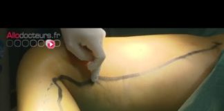 Le traitement des varices par radiofréquence Varices-le-traitement-par-radiofrequence-Allo-Docteurs