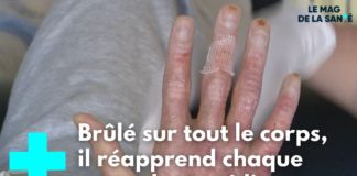 La longue convalescence des grands brûlés Grands-brules-une-longue-convalescence-